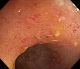 Crohns lesions in distal ileum