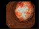 GIST tumor in colon