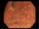 Lateral-spreading tumor in colon