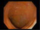 Distal ileum at colonoscopy