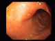 Small duodenal ulcer
