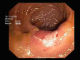 Anastomotic ulceration